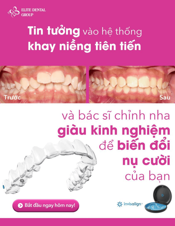 Kết quả trước và sau khi bé T.A niềng răng Invisalign tại Elite Dental