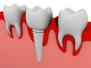 Trồng răng Implant số 7