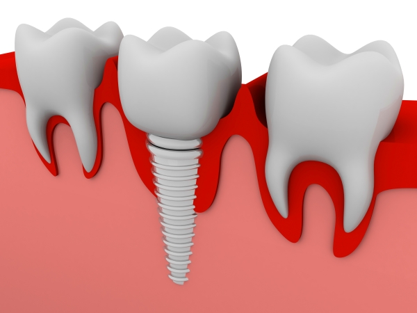 Trồng răng Implant số 7