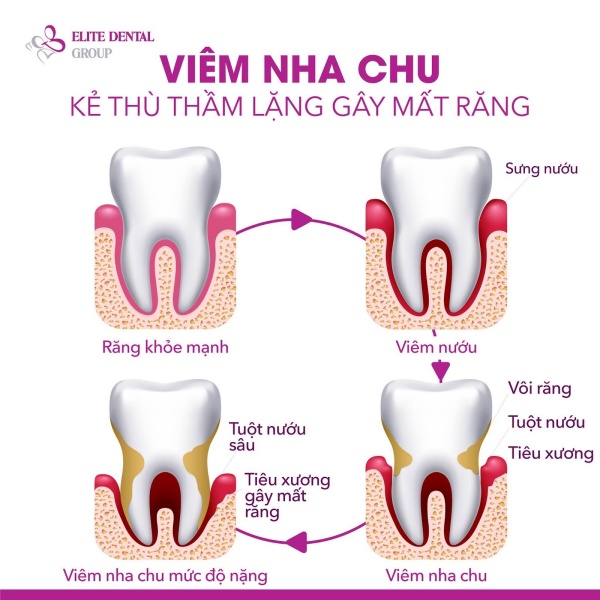 Viêm nha chu có thể gây tiêu xương răng