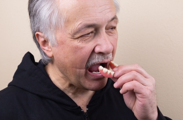 Hàm răng nhựa dẻo thường