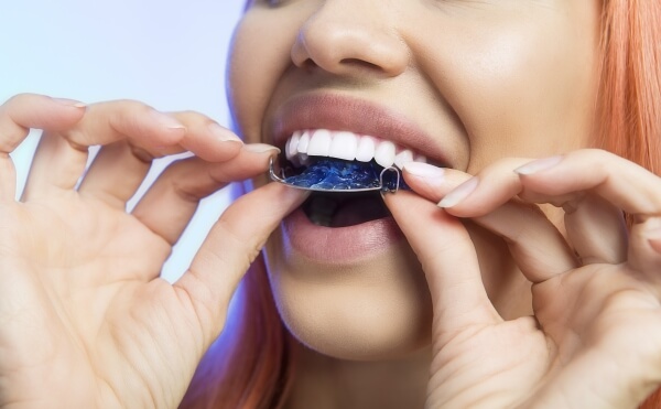 Đeo hàm duy trì sau khi niềng giúp răng ổn định, tránh xô lệch