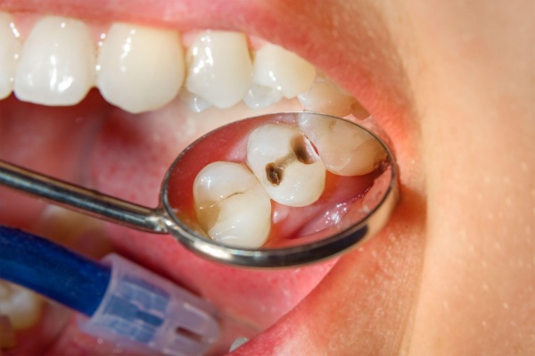 Những vết đen xuất hiện trên mặt răng
