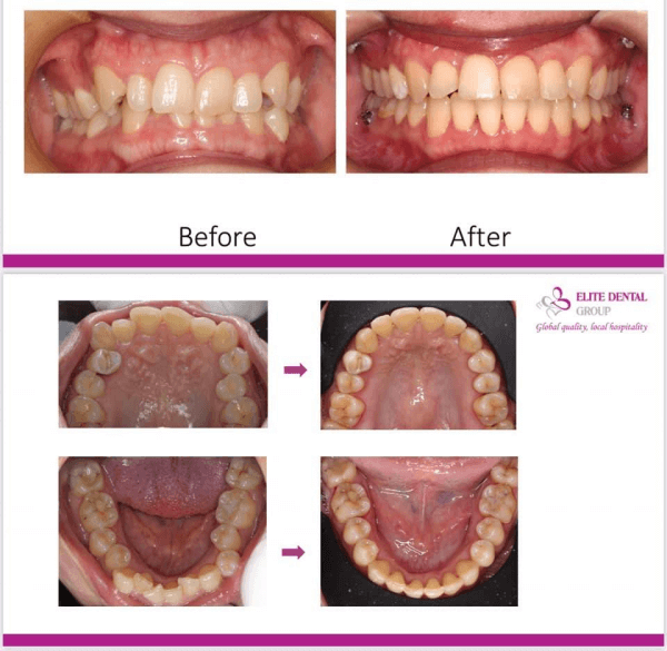 Hình ảnh của khách hàng trước và sau khi niềng răng mọc chen chúc tại Elite Dental