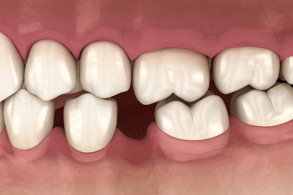 Nguyên nhân niềng răng bị hóp má do mất răng