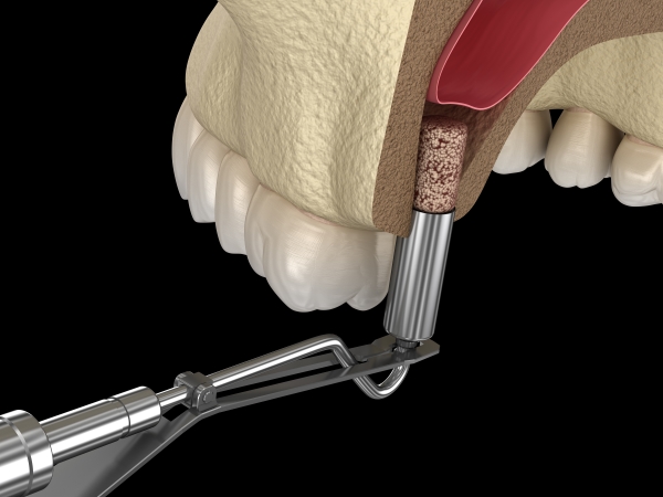 Nâng xoang hàm trong cấy ghép Implant