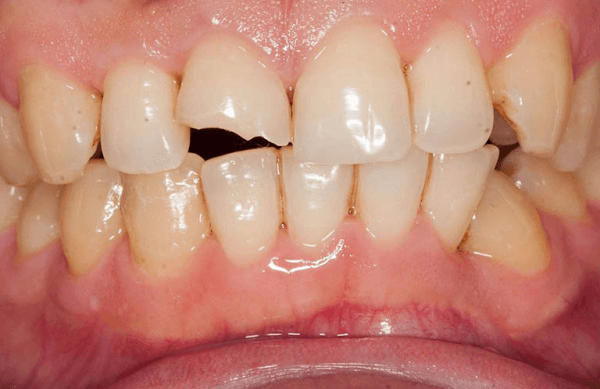 răng bị mẻ hoặc vỡ