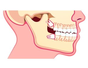 Răng khôn mọc lệch để lại nhiều biến chứng nghiêm trọng