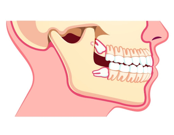 Răng khôn nằm ngang góc 45-90 độ so với răng số 7