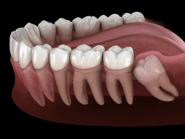răng khôn mọc ngầm trong xương 