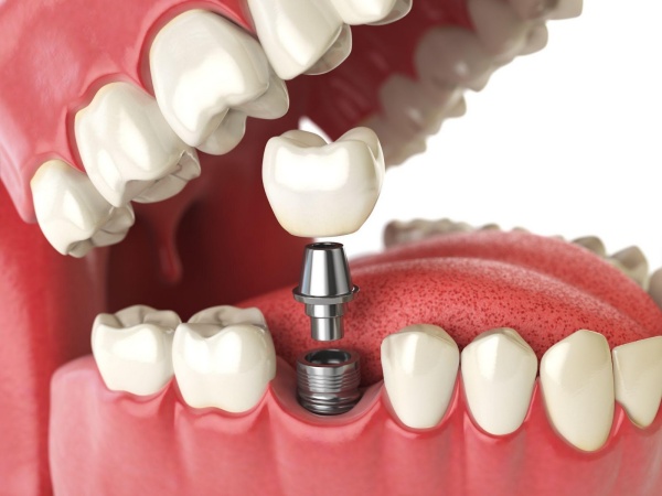 Trồng răng Implant giúp khắc phục tình trạng tiêu xương sau nhổ răng