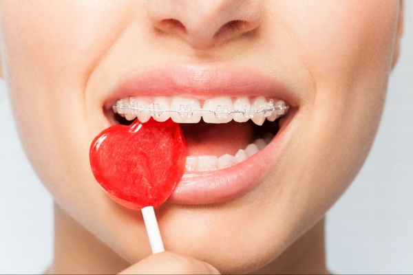 Không nên ăn các thực phẩm nhiều đường trong giai đoạn niềng răng