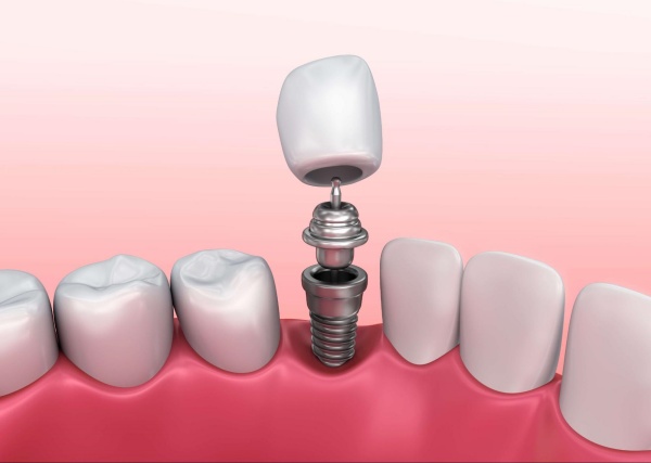 Răng toàn sứ trên Implant