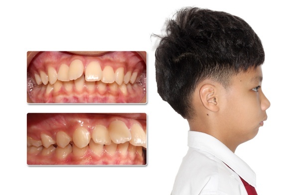 Hình ảnh khuôn mặt của cậu bạn 9 tuổi với tình trạng cằm lẹm (cằm ngắn) khiến gương mặt bị thiếu cân đối.