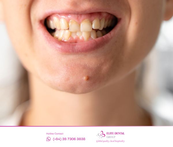 Sai lệch khớp cắn dẫn đến lẹm cằm