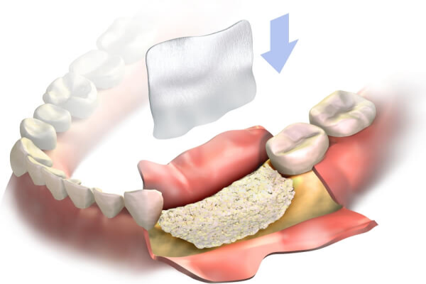 Điều trị ghép xương trước khi niềng răng