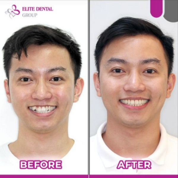 Khuôn mặt của khách hàng thay đổi sau khi điều trị hô xương
