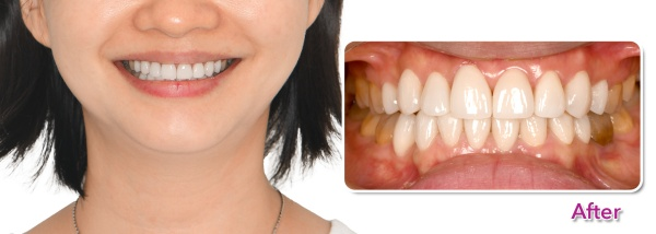 Răng của khách hàng sau khi điều trị