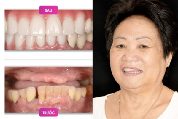 Răng của khách hàng sau khi phục hồii