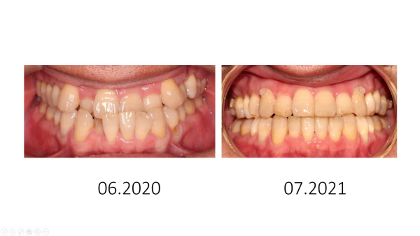 Răng của khách hàng sau một năm điều trị