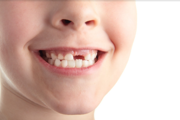 Răng rụng sớm nếu nắn chỉnh sai cách