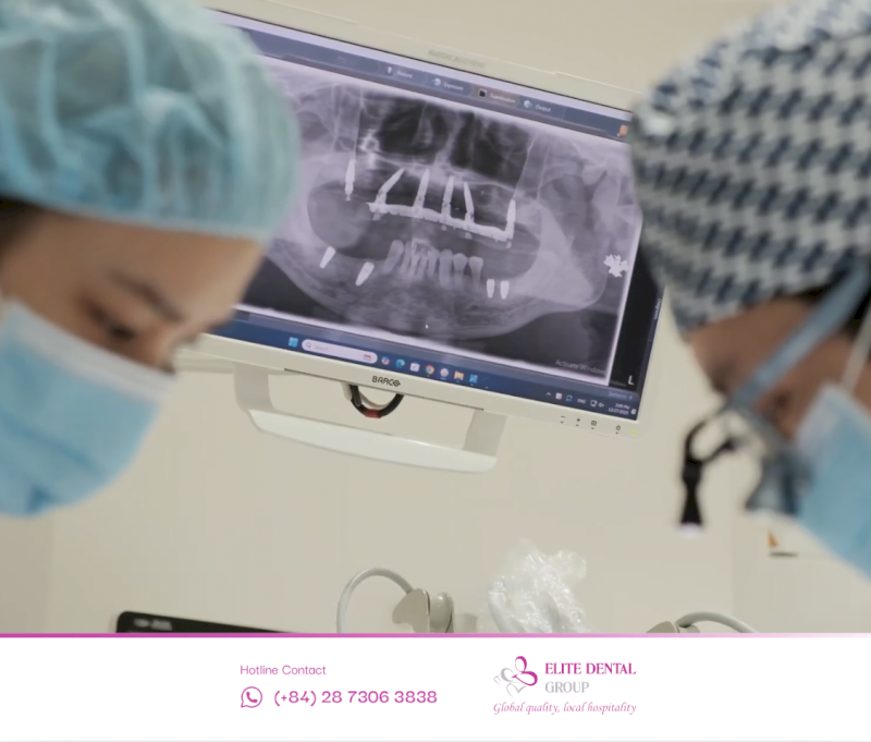 Phương pháp cấy Implant Loại 2 giúp mô nướu ổn định giảm nguy cơ nhiễm khuẩn và có tỷ lệ thành công cao