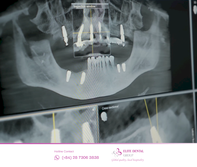 Xương phục hồi giúp Implant ổn định giảm nguy cơ nhiễm trùng và phẫu thuật đơn giản hơn