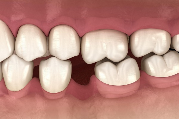 Tiêu biến chân răng khiến răng bị yếu đi sau khi niềng