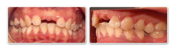 Tình trạng răng trước khi điều trị