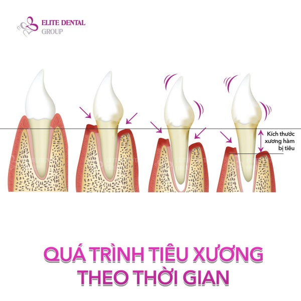Trồng răng Implant giúp ngăn ngừa quá trình tiêu xương