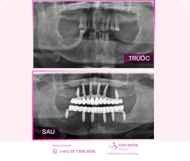 Trước và sau khi trồng răng Implant All-on-6