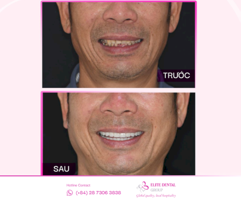Răng trên Implant được thiết kế tự nhiên, độ thẩm mỹ cao