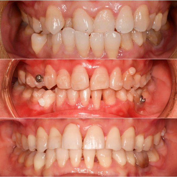 Trước, trong và sau khi chỉnh răng