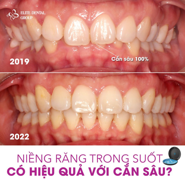 Trước và sau khi niềng răng trong suốt