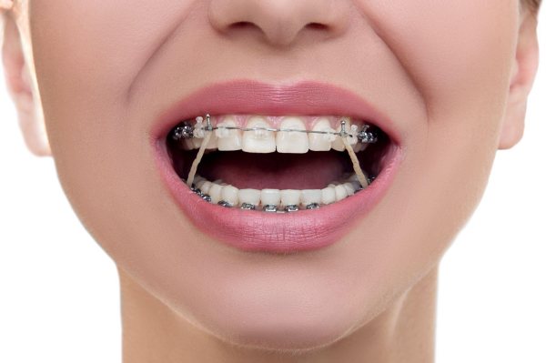 Đeo thun liên hàm giúp kéo răng lệch lạc nhanh chóng