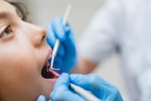 Điều trị răng sâu trước khi niềng răng