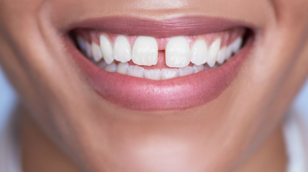 Kẽ răng bị hở ảnh hưởng đến nụ cười