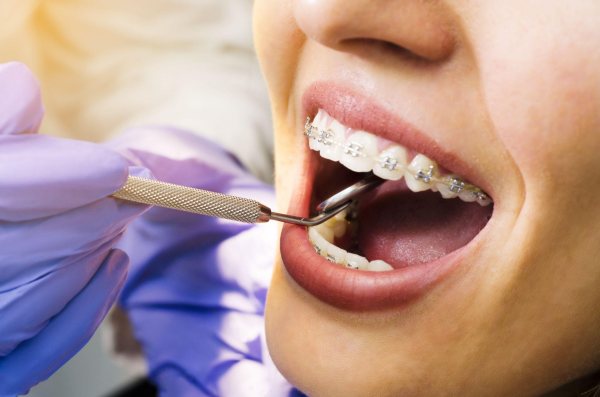 Niềng răng đúng cách không gây ảnh hưởng đến sức khỏe hệ thần kinh