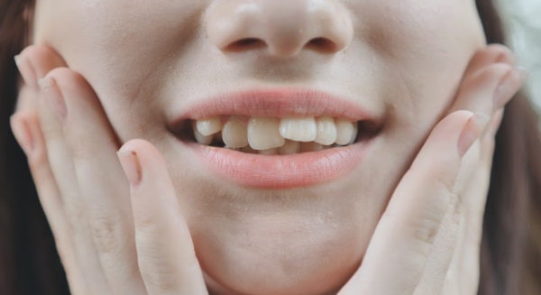 Răng bị chạy lại sau khi niềng răng do nhiều nguyên nhân