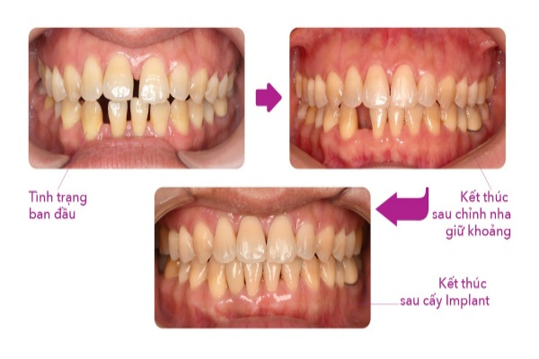 Răng bị hở kẽ trước và sau khi chỉnh nha