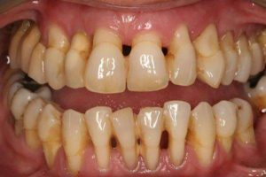 Răng bị xô lệch nếu không điều trị sớm sẽ bị viêm nha chu