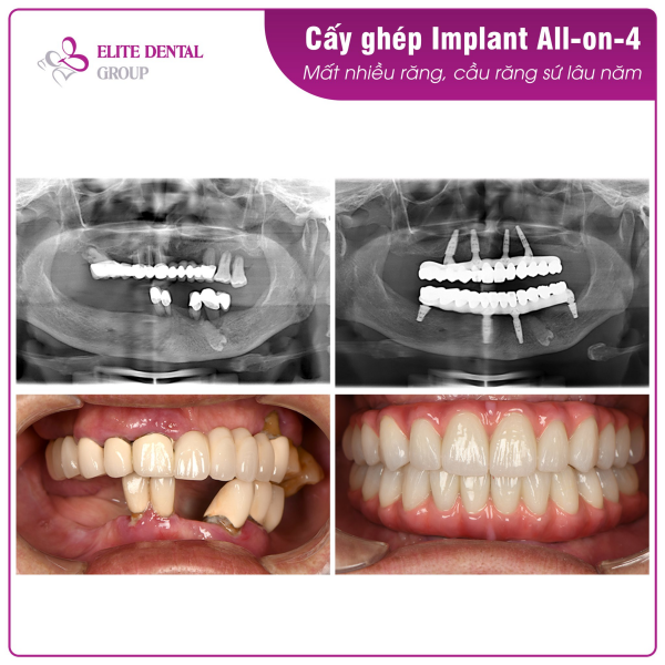 Răng của khách hàng trước và sau khi trồng Implant