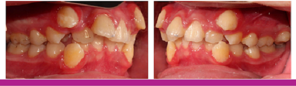 Răng mọc lộn xộn ảnh hưởng đến sức khỏe răng miệng