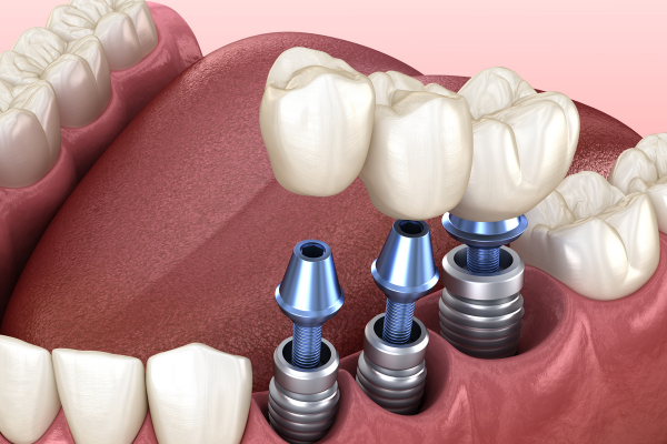 Trồng răng implant giúp phục hồi răng mất