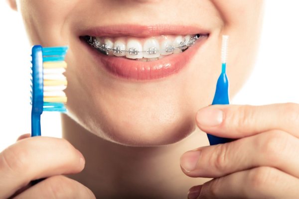Vệ sinh răng miệng đúng cách sau khi niềng răng