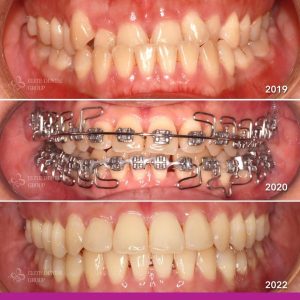 Quá trình thay đổi răng của bệnh nhân sau nâng khớp hàm răng