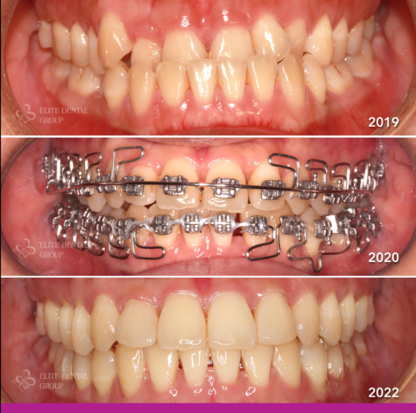 Răng của bệnh nhân thay đổi sau hành trình ba năm niềng răng