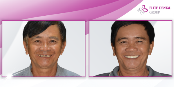 Răng của khách hàng trước và sau điều trị cấy Implant