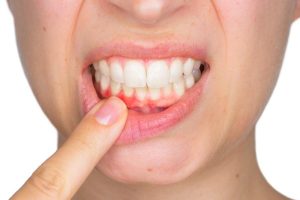 Trồng răng Implant gây dị ứng có thể làm sưng đau, tấy đỏ,...