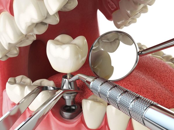 Trồng răng Implant gây dị ứng trong một số trường hợp đặc biệt